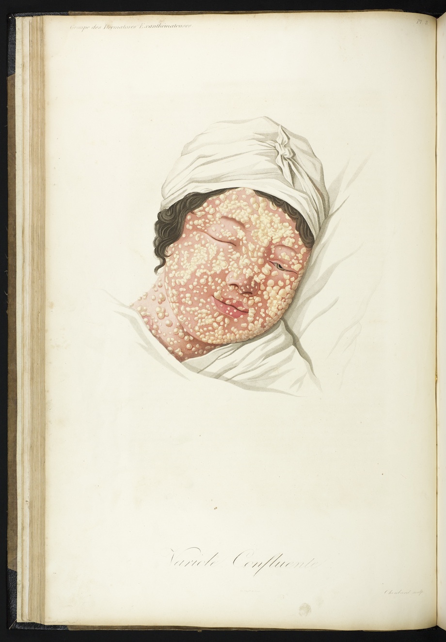 "Variole Confluente" (smallpox with a confluent rash). Courtesy the Lilly Library, Indiana University, Bloomington, Indiana. 
