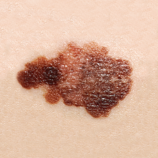 New Exciting Advance In Melanoma Treatment Lakeview Dermatology Chicago