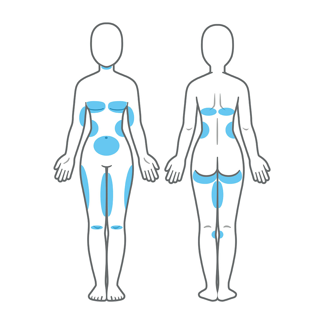 CoolSculpting Procedure  Illinois Dermatology Institute