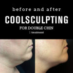 BeforeAfterPhotos_CoolSculpting2_DoubleChin