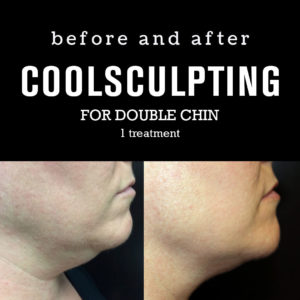 BeforeAfterPhotos_CoolSculpting2_DoubleChin