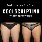 BeforeAfterPhotos_CoolSculpting4_Inner Thighs