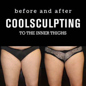 BeforeAfterPhotos_CoolSculpting4_Inner Thighs