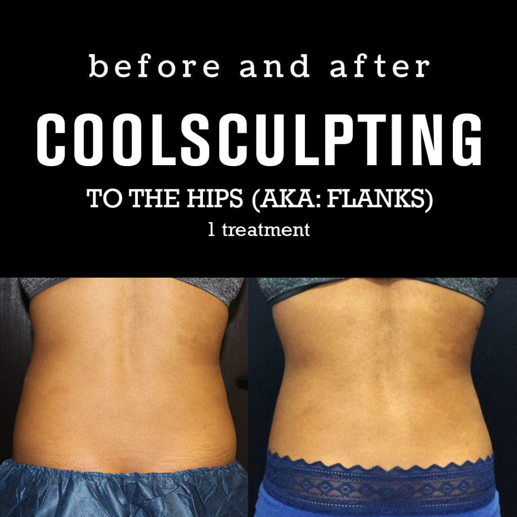 BeforeAfterPhotos_CoolSculpting5_Flanks