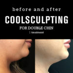 BeforeAfterPhotos_CoolSculpting8_double chin