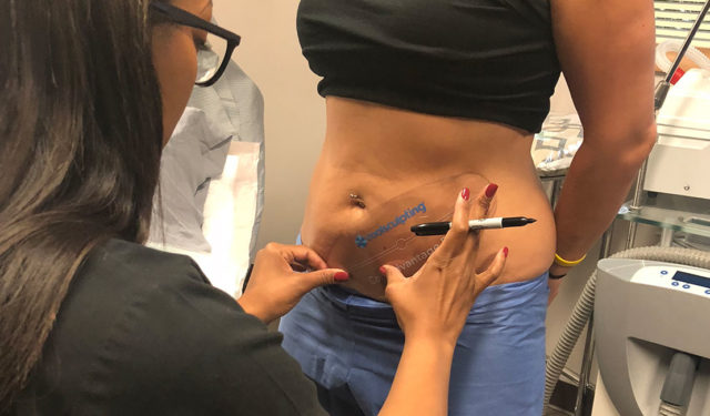 March Special: Free CoolSculpting Consults in Lakeview
